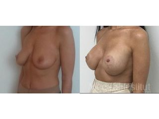 Modelácia prsníkov (Mastopexia) - MUDr. Martin Šimkanin