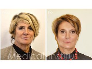 Facelift, SMAS facelifting - MUDr. Martin Šimkanin