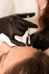 Botulotoxín na vyhladenie mimických vrások, estetická medicína BeautyLab Bratislava