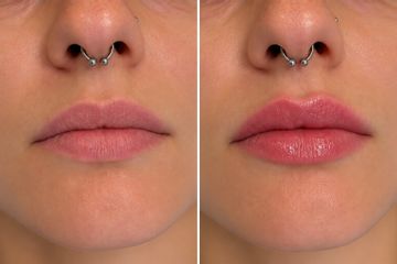 Zväčšenie pier kyselinou hyalurónovou pred a po, MUDr. Sabina Lauková, BeautyLab Bratislava