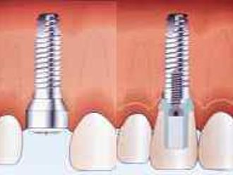 Zubné implantáty - 804550