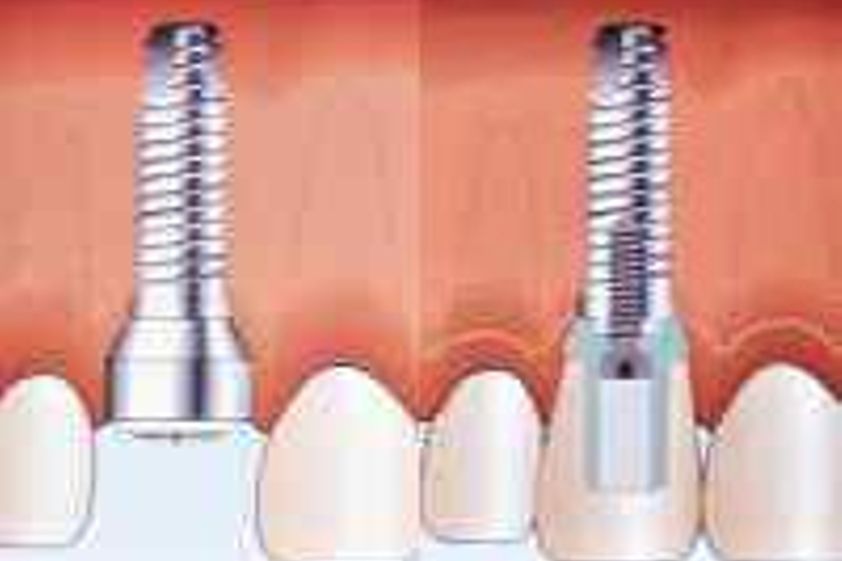 Zubné implantáty pred a po - 804550