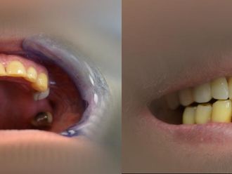 Zubné implantáty - 804552