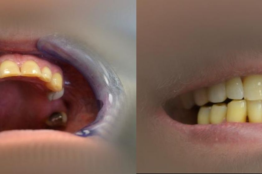 Zubné implantáty pred a po - 804552