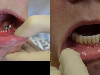 Zubné implantáty - 804554