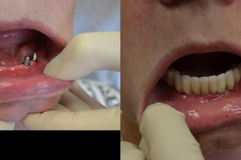 Zubné implantáty pred a po - 804554