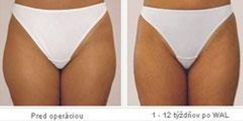 liposukcia3 1240424475