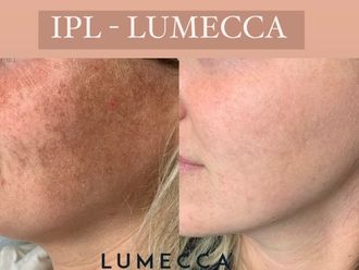 Laserová dermatológia pred a po - 860545