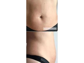 Alternatíva liposukcie - MUDr. Diana Višňovská