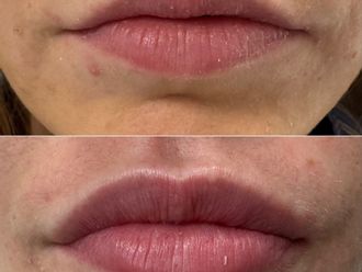 Kyselina hyalurónová pred a po - 878471