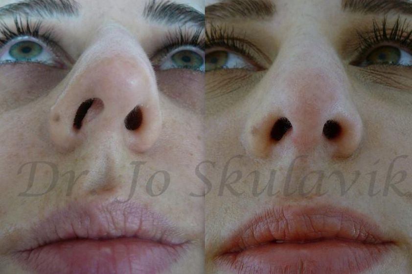 Rhinoplastika pred a po - 802363