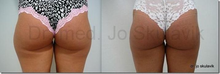 lipo1