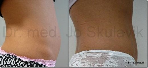 lipo2
