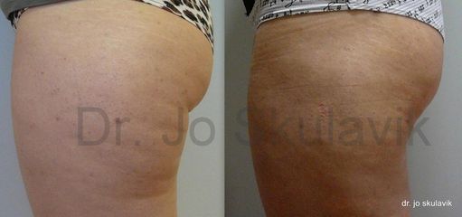lipo3