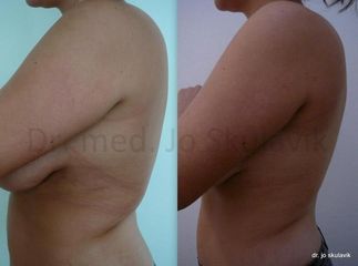 liposukce 2