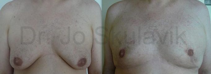 gyneko 1