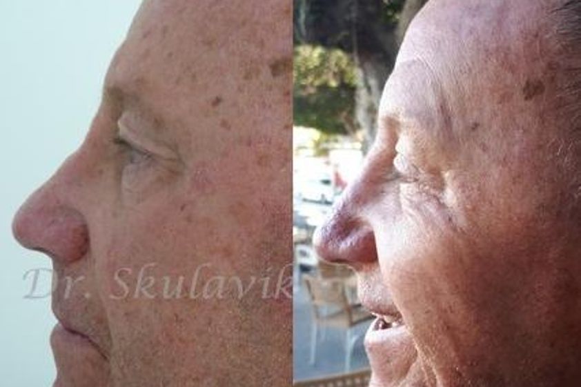 Rhinoplastika pred a po - 802547