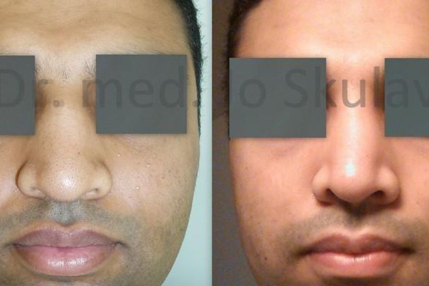 Rhinoplastika pred a po - 802610