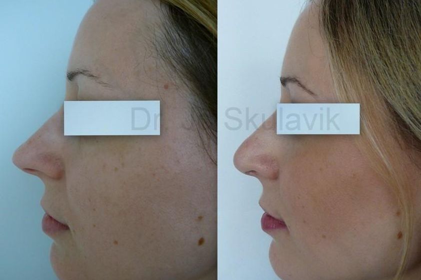Rhinoplastika pred a po - 802671