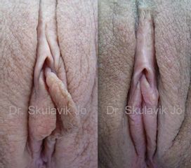 BEFORE labiaplasty4