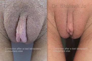 BEFORE secondary labiaplasty