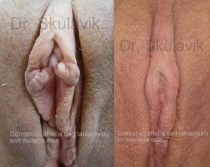 BEFORE secondary labiaplasty1