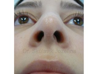 Operácia nosa (Rhinoplastika) - Dr. med. Jozefina Skulavik