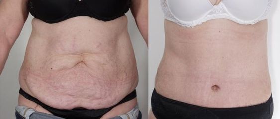 phoca thumb l abdominoplastika