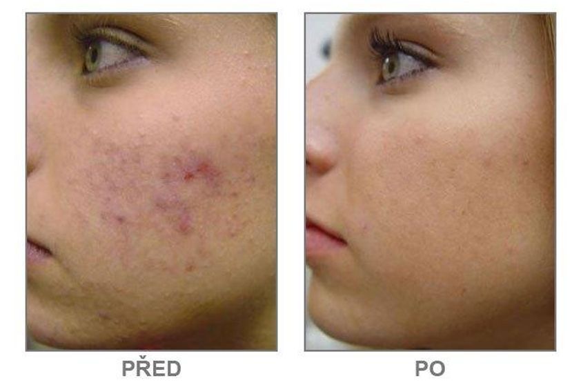 Chemický peeling pred a po - 805999