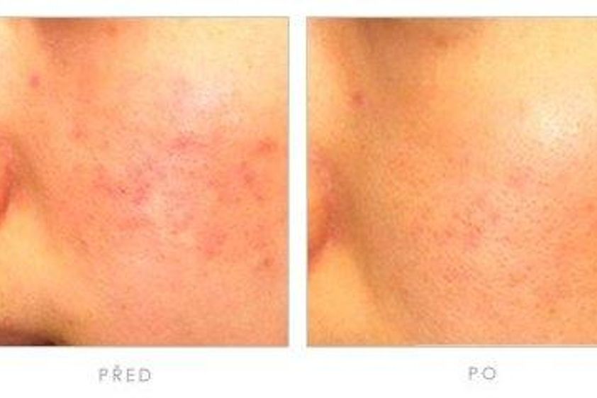 Mezoterapia pred a po - 806005