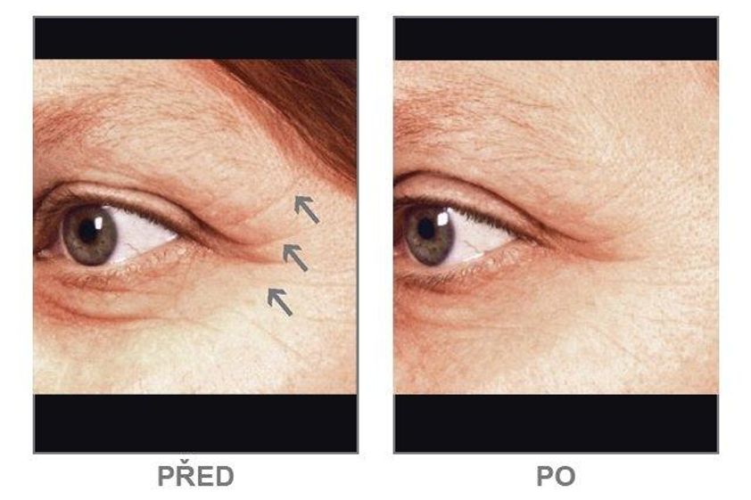 Rádiofrekvencia pred a po - 806010