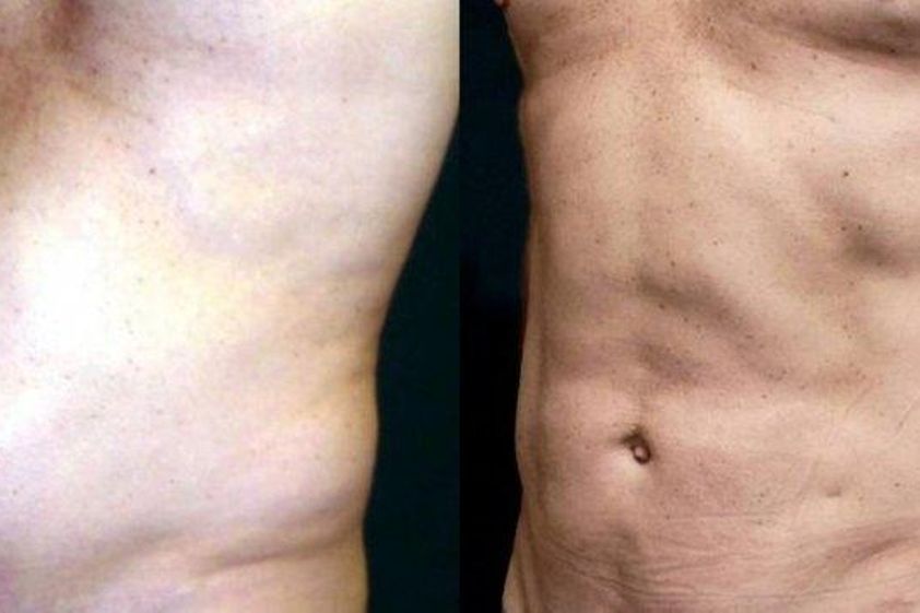 Neinvazívna liposukcia pred a po - 806014