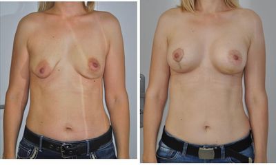 Augmentácia s modeláciou s anatomickými implantátmi