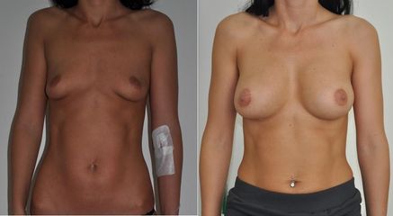 Zväčšenie prsníkov, anatomické implantáty
