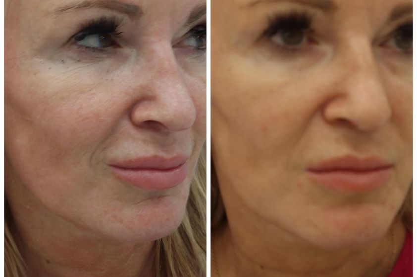Anti aging pred a po - 855682
