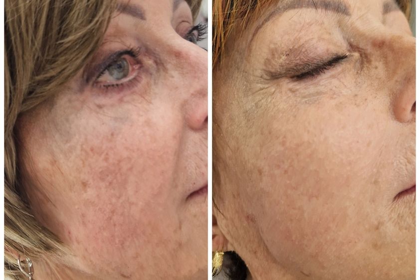 Anti aging pred a po - 861809