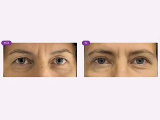 Operácia očných viečok (Blepharoplastika)