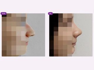 Operácia nosa (Rhinoplastika)