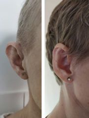 Operácia uší (Otoplastika) - MUDr. Andrej Divok