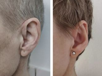 Operácia uší (Otoplastika) - 815435