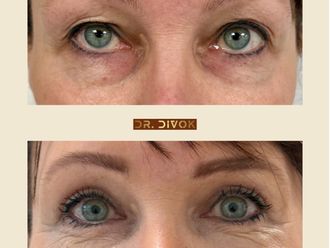Blefaroplastika pred a po - 874448