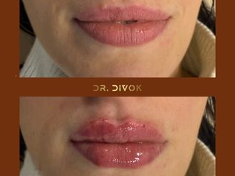 Zväčšenie pier pred a po - 878660