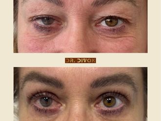 Blefaroplastika pred a po - 878661