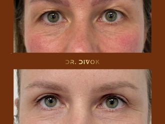 Blefaroplastika pred a po - 878662