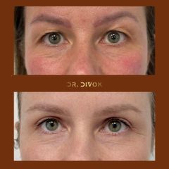 Blefaroplastika HV