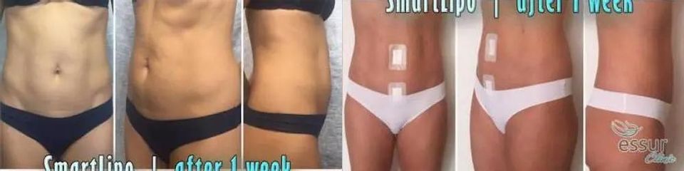 BEFORE smartlipo vysledok 1 (1)