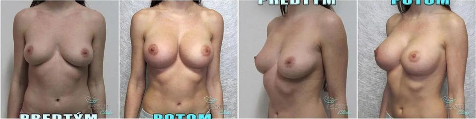 BEFORE augmentacia 002 1080