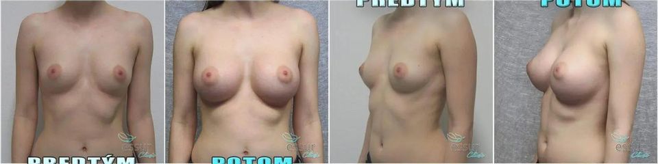BEFORE augmentacia 004 1080