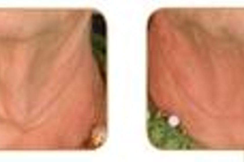 Plazma terapia pred a po - 804723