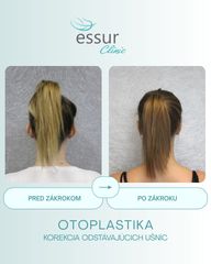 Otoplastika